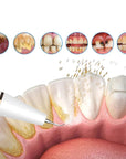 FreshScale - Ultrasound Plaque & Tartar Eliminator 1