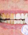 SmileSnap | Perfect Veneer Snap-On Teeth for a Confident Smile 3