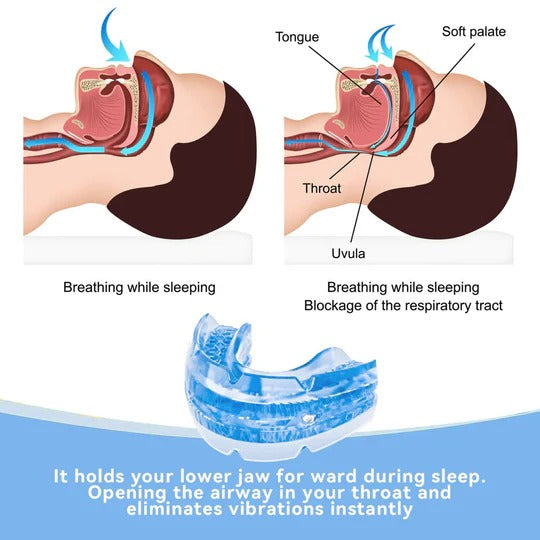 AureaGuard | Comfortable Adjustable Anti-Snoring Mouthpiece Guard 2