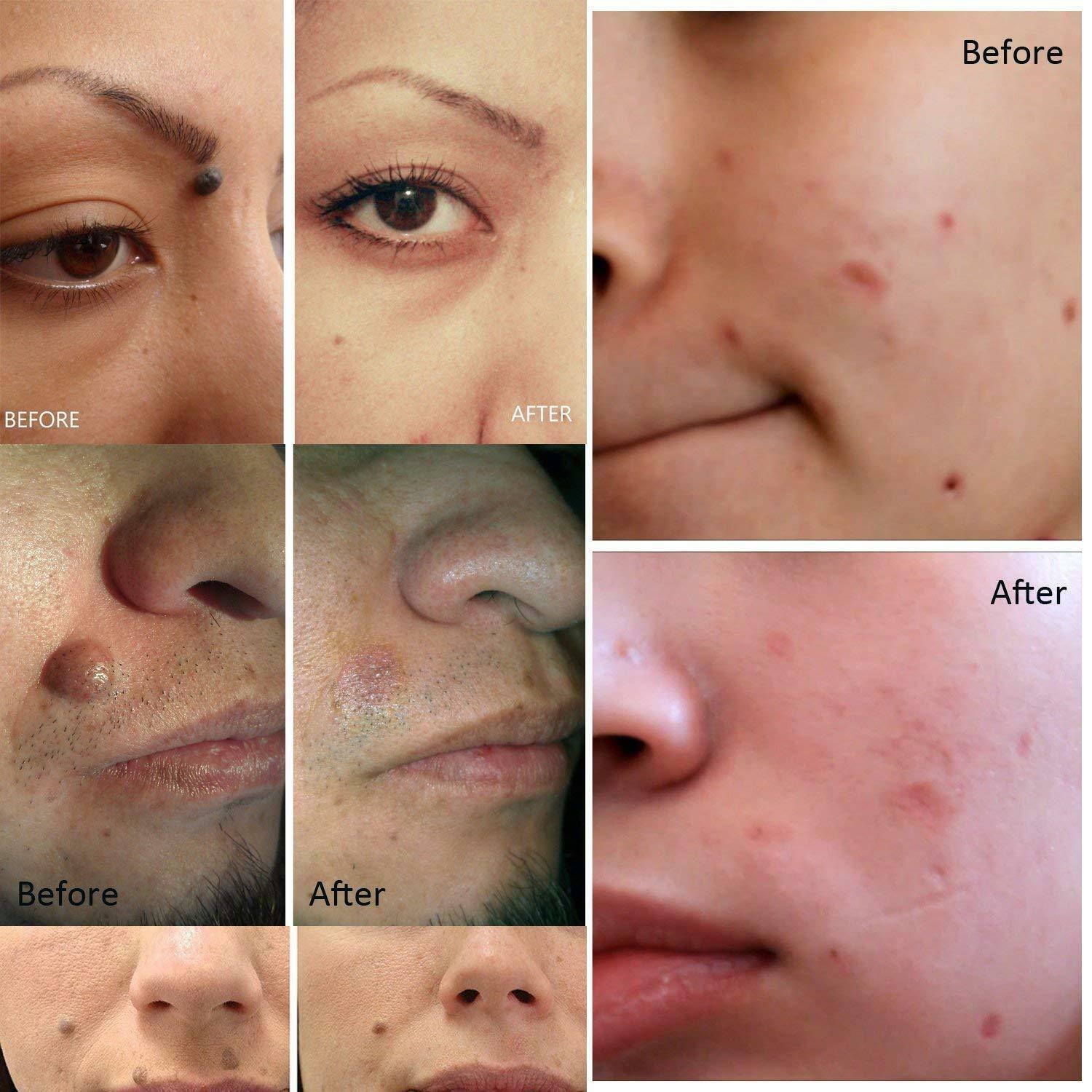 ElysiumGlow | Efficient Portable Skin Blemish Removal Pen 7