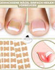 FixaNail | Nail Correction Tool for Ingrown Nails and Gentle Pain Relief 1