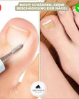 FixaNail | Nail Correction Tool for Ingrown Nails and Gentle Pain Relief 4