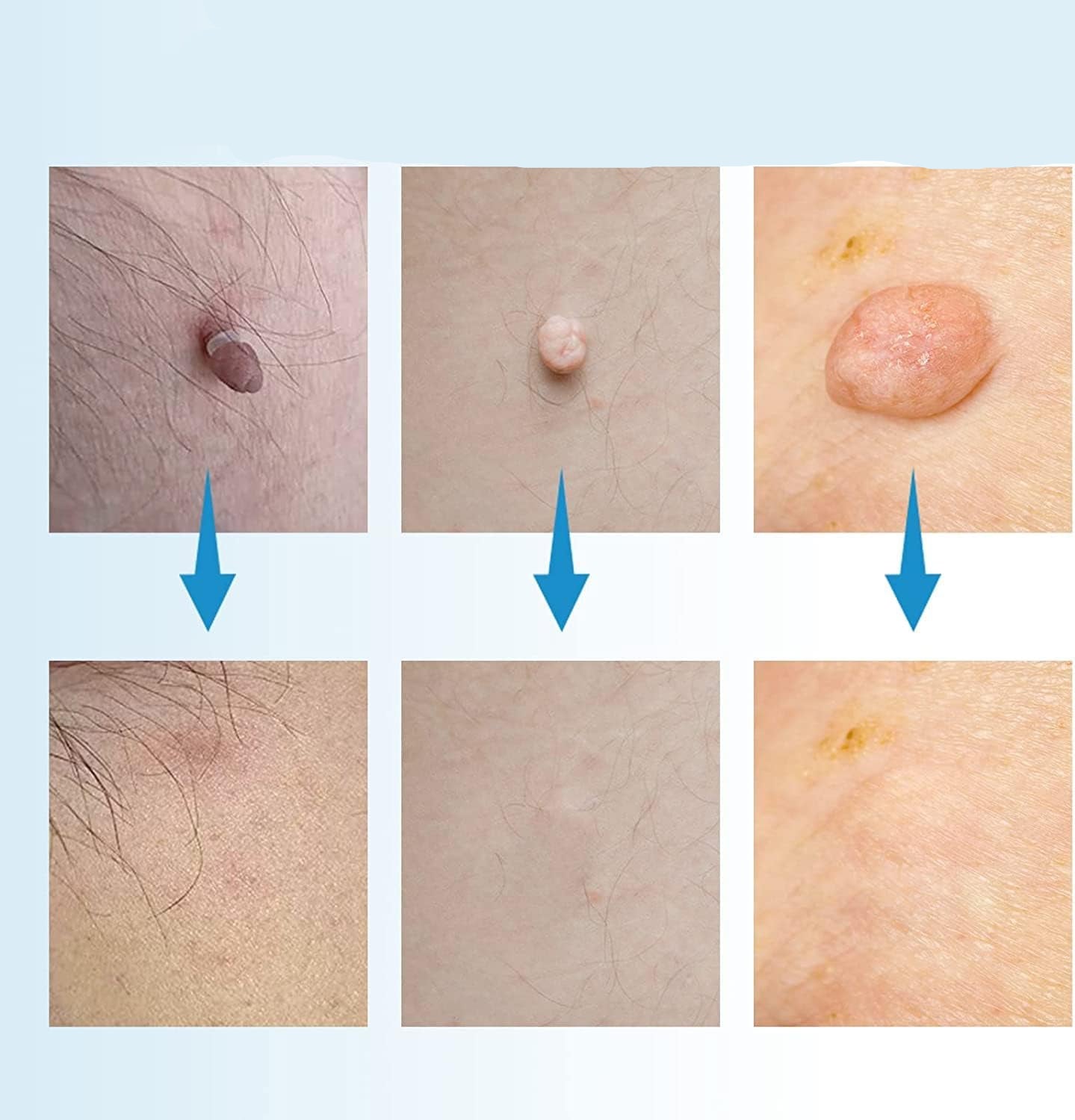 Skin Tag Remover Kit for Painless Removal of Skin Tags, Warts, and Moles – Fast Results at Home 1