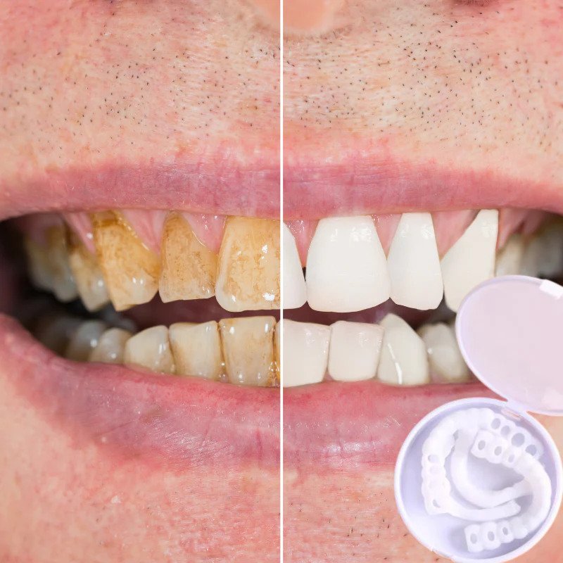 SmileSnap | Perfect Veneer Snap-On Teeth for a Confident Smile 3
